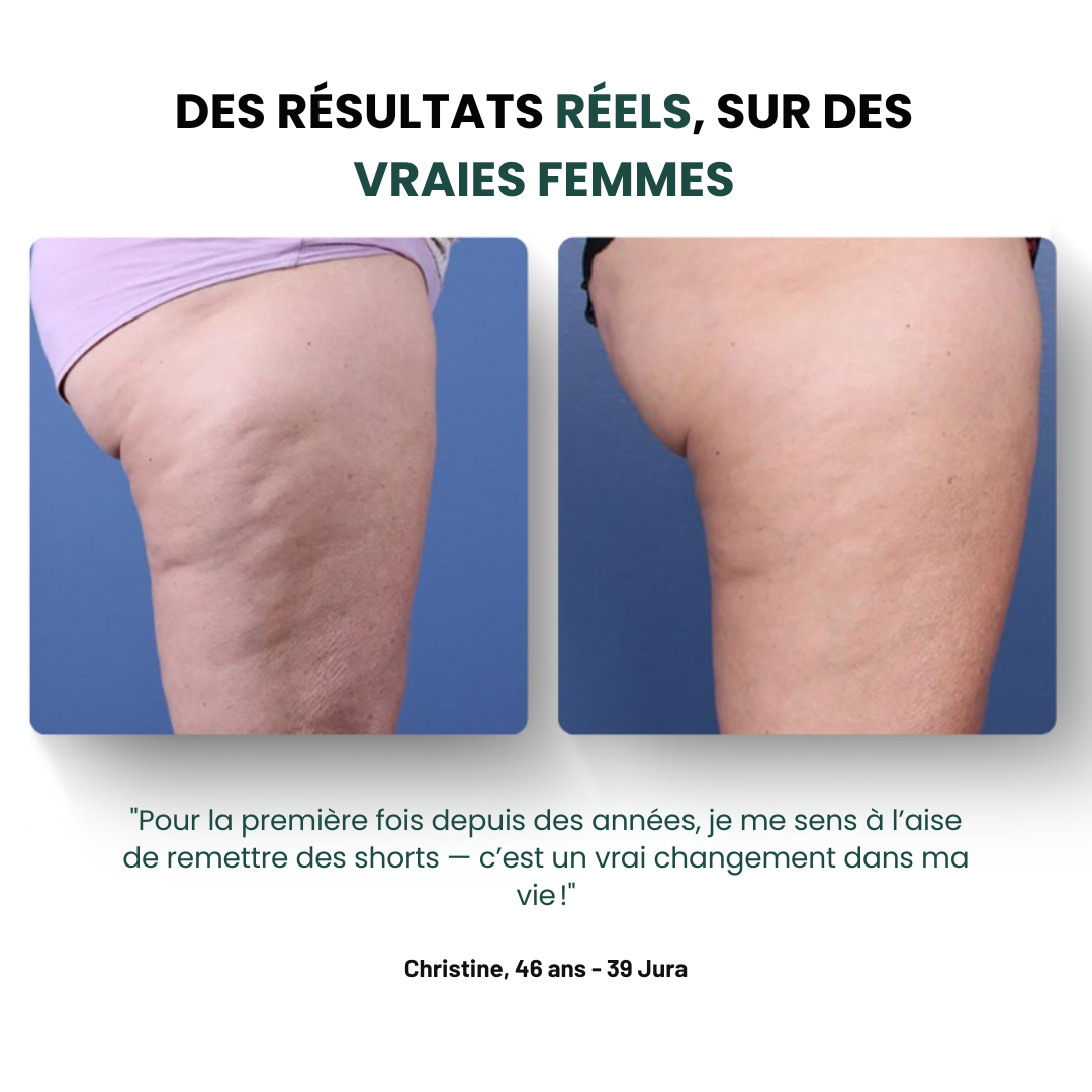 BeGlowave™ Anti-Cellulite 3 en 1